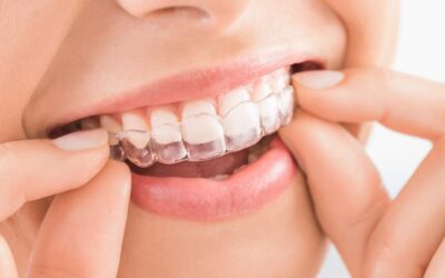 Beneficios de Invisalign: La forma discreta de alinear tu sonrisa