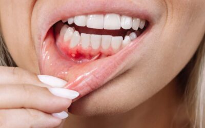 Cómo identificar y tratar la enfermedad periodontal antes de que sea tarde